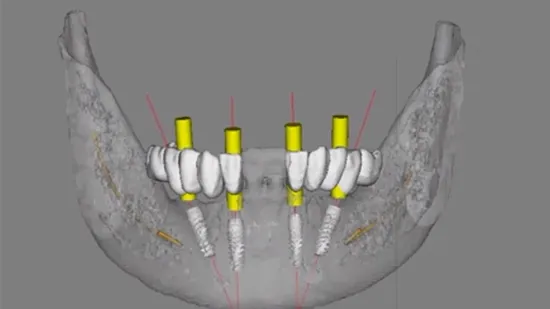 Dental Laboratory Denture 3D Metal Printed Partial Removable Denture for Dental Clinic 